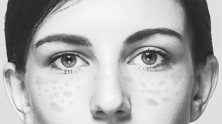 diagnostico-y-tratamiento-de-melasma-pano